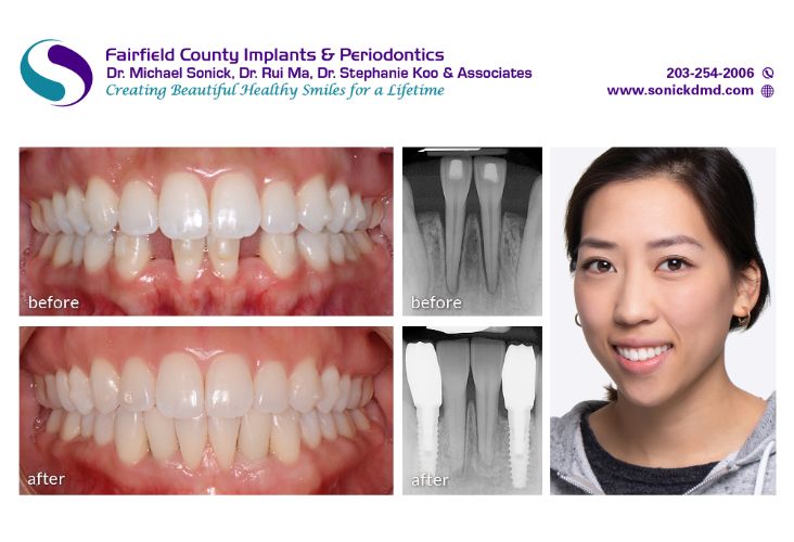 Before and after patient photos