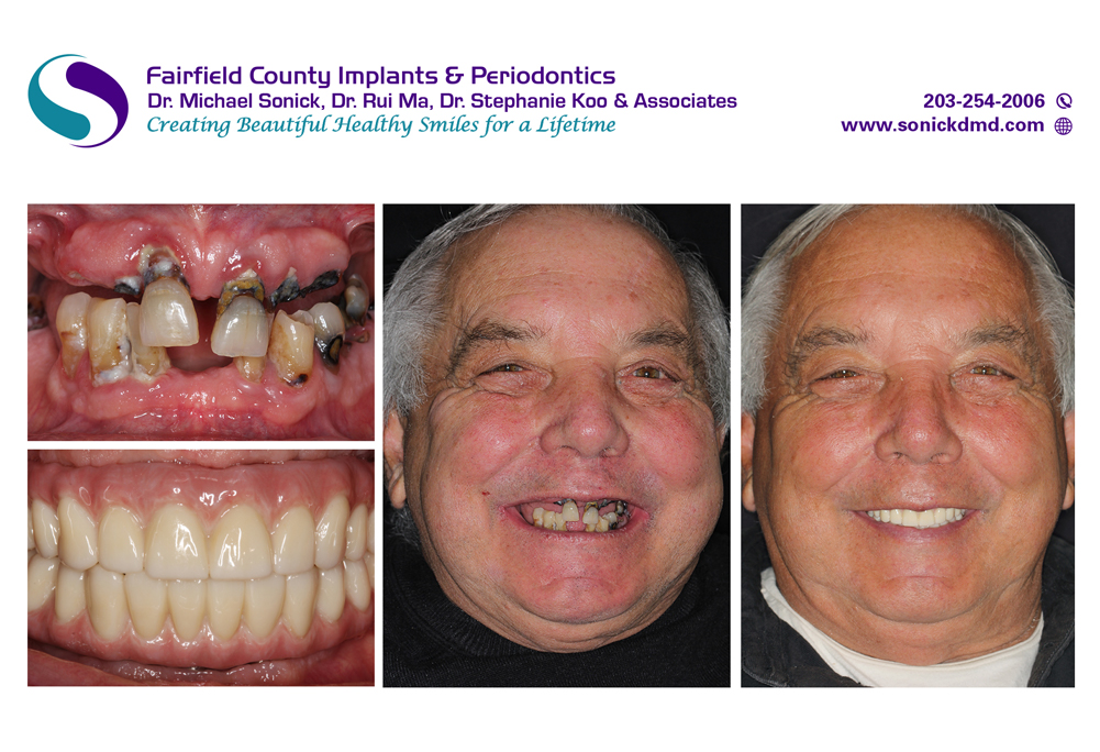 Before and after patient photos