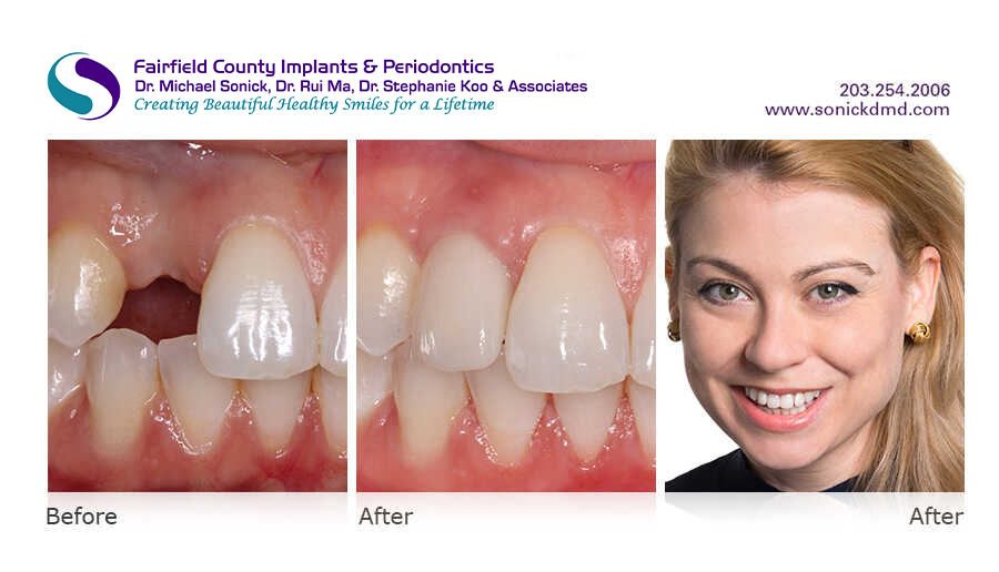 Before and after patient photos