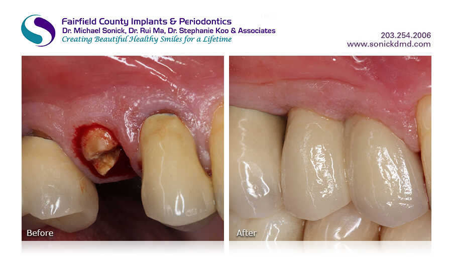 Before and after patient photos